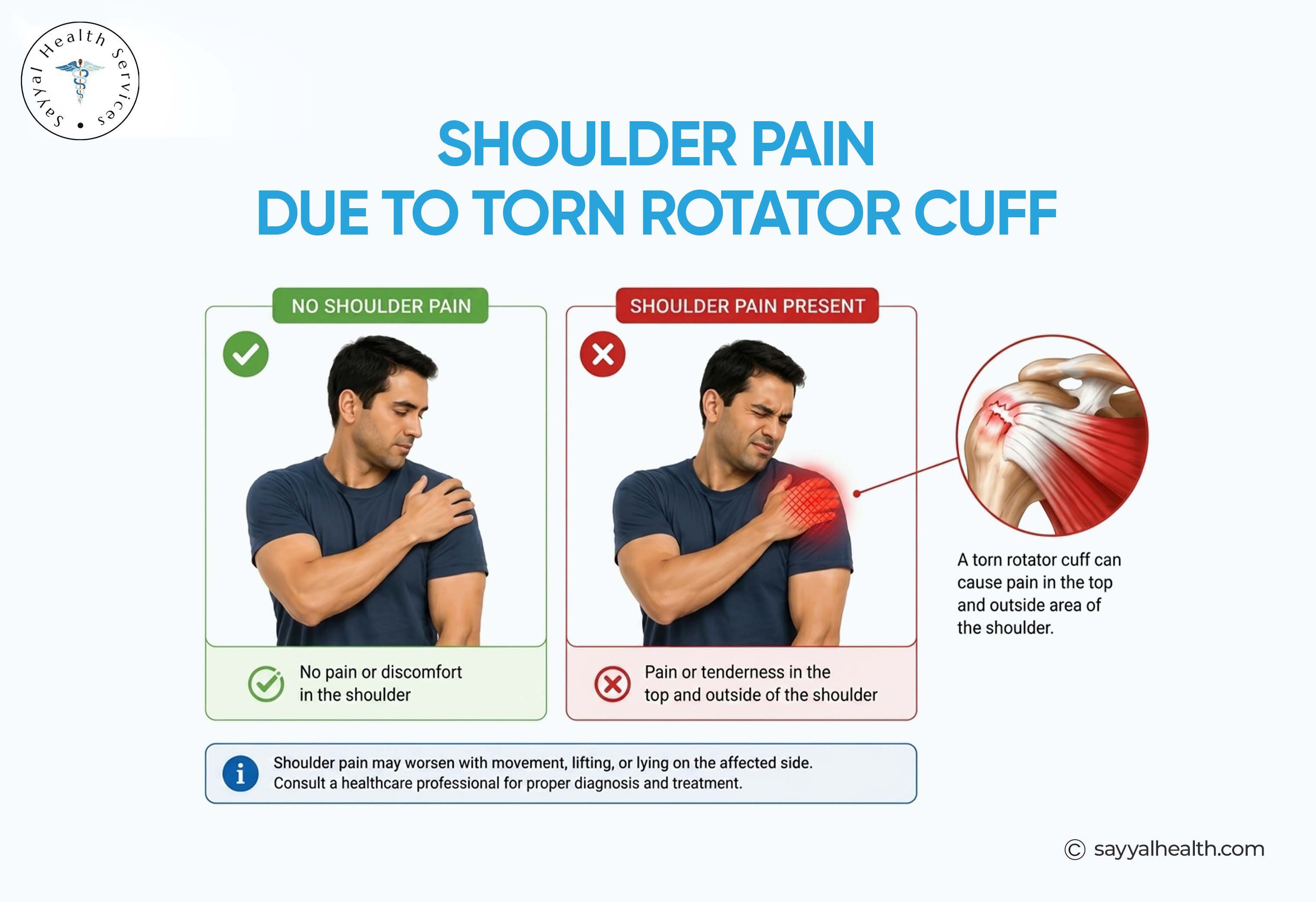 shoulder pain due to torn rotator cuff